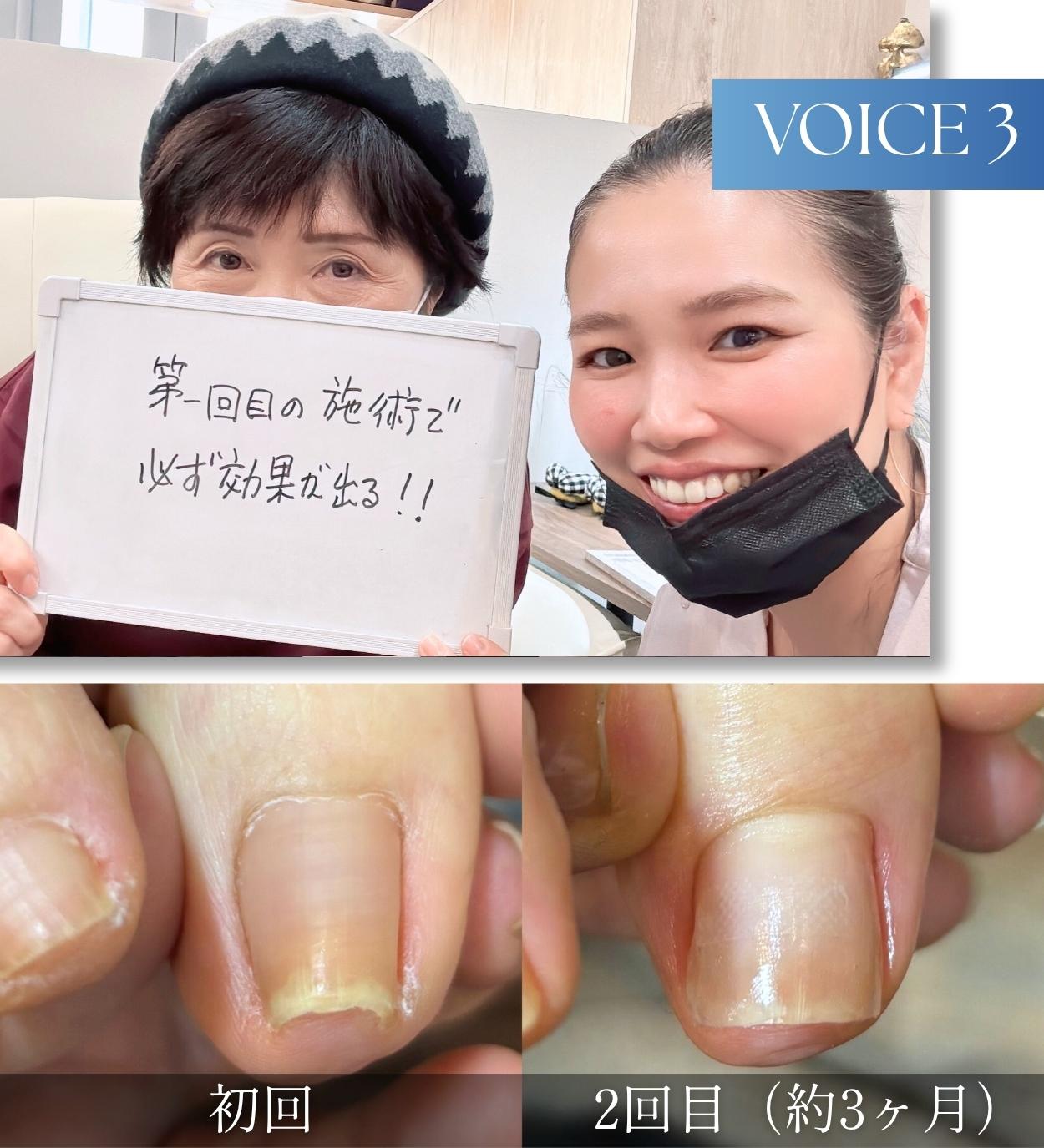 巻き爪で悩んでいたお客様の声3